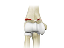 Elbow Fractures