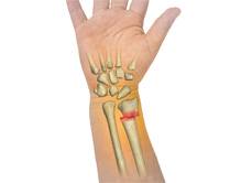 Forearm Fractures in Children
