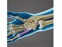 Fractures of the Hand and Fingers