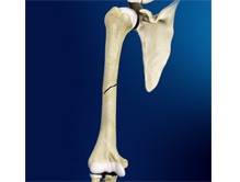 Mid-shaft Humerus Fracture