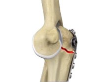 Non-union Surgery (Elbow)