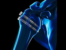 ORIF Proximal Humerus Fracture