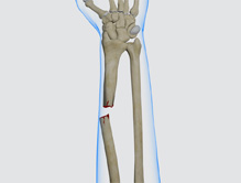 Pediatric Forearm Fracture