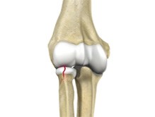Radial Head Fractures of the Elbow