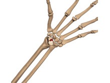 Scaphoid Fracture