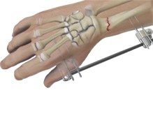 Wrist Fracture Fixation