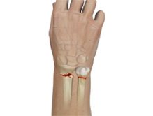 Wrist Fracture