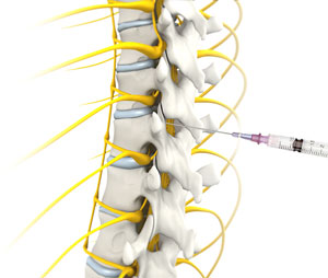 Epidural Steroid Injection