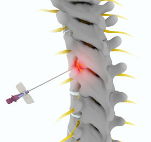 Facet Joint Injection
