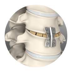 ACDF Cervical Fusion img