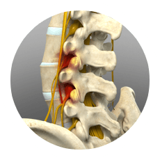 Lumbar Decompression img