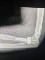 After Elbow Surgery -1