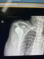 Patient Success Story 3-2