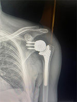 Patient Success Story 4-1