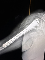 Patient Success Story 7-1