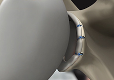 picture of Anterior Shoulder Stabilization