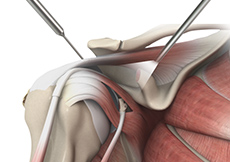picture of Arthroscopic Latarjet for Shoulder Instability