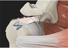 picture of Arthroscopic Superior Capsular Reconstruction