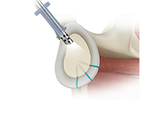 picture of Complex Shoulder Reconstruction