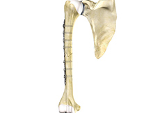 picture of Humeral Shaft Fracture Repair