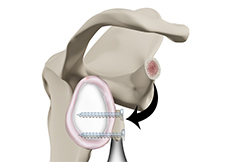 picture of Latarjet Procedure