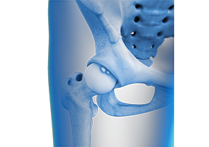 Loose Bodies in the Knee