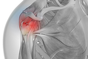 Massive Retracted Rotator Cuff Tear
