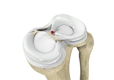 Meniscal Tears
