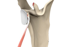 picture of Open Shoulder Stabilization