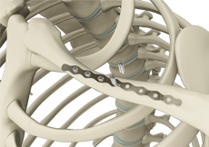 picture of ORIF of Clavicle Fractures