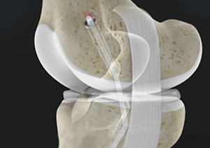 PCL Reconstruction