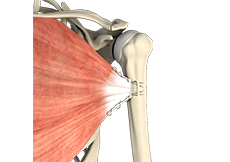 picture of Pectoralis Major Tears/Repairs