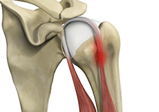 picture of Proximal Biceps Tenodesis
