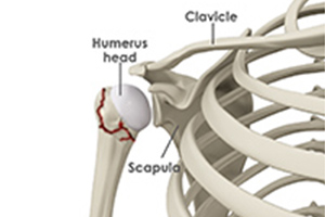 Proximal Humerus Fractures