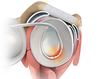 picture of Revision Open Labral Repair