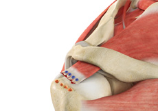 picture of Revision Rotator Cuff Surgery