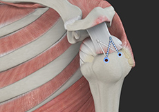 picture of Rotator Cuff Repair