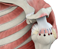 picture of Rotator Cuff Surgery Frequently Asked Questions