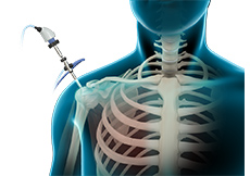 picture of Shoulder Arthroscopy