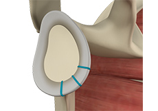 picture of Shoulder Labrum Reconstruction