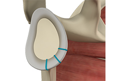 picture of Shoulder Stabilization