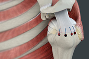 Shoulder Surgery