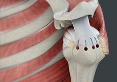 picture of Shoulder Surgery
