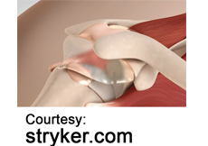 picture of Stryker InSpace for Rotator Cuff Tears