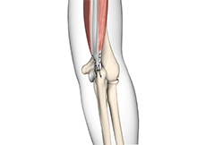picture of Triceps Repair