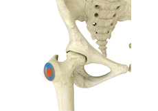 Trochanteric Bursa Injections
