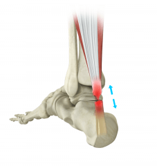 Achilles Tendon Repair
