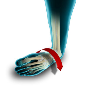 Ankle Instability