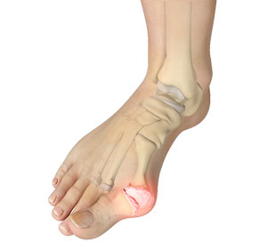 Bunion