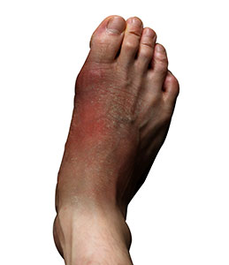 Foot Infections 